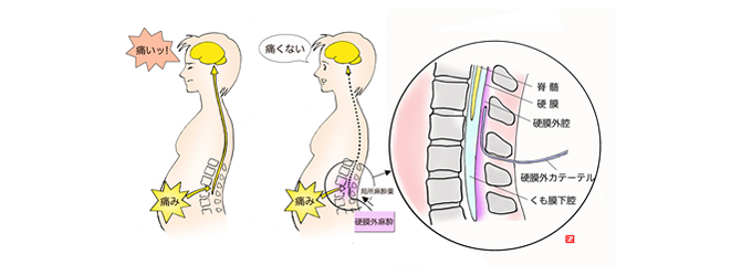 硬膜外無痛分娩